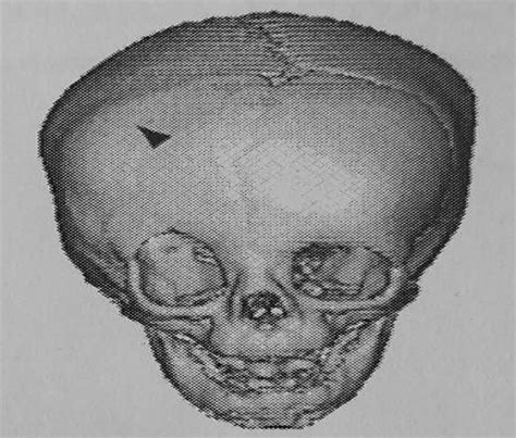 Unilateral Coronal Craniosynostosis in Abraham Lincoln and H ...