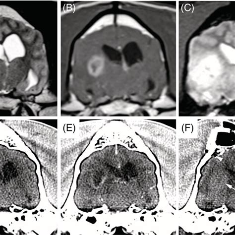 Pneumocephalus And Iatrogenic Intratumoral Hemorrhage After