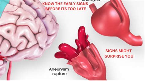 What Is Aneurysm 3 Most Common Types Explained Youtube