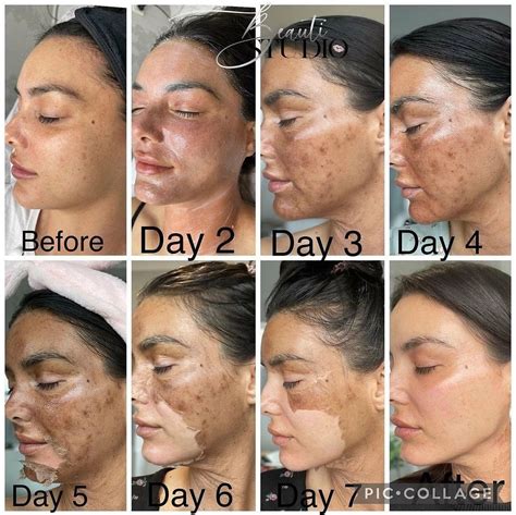 Skin Renewal Peel Consultation Elaine Brennan