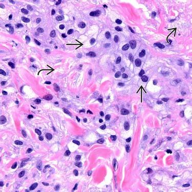 Xanthoma Histology