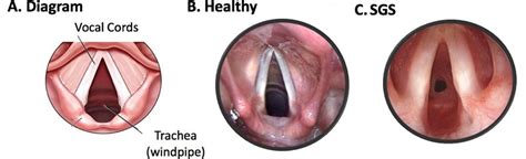 Subglottic Stenosis Clinical Features And Treatment Ear Nose Throat