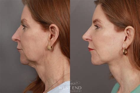 Face Procedures Before And After Gallery West End Plastic Surgery