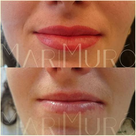 Before And After Pictures Of Lip Fillers On The Lips From Top To Bottom