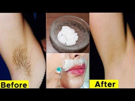 In Minute Remove Unwanted Armpit Or Facial Hair Permanently Ll