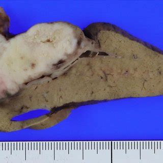 Gross Resected Specimen The Tumor Size Was Mm Its