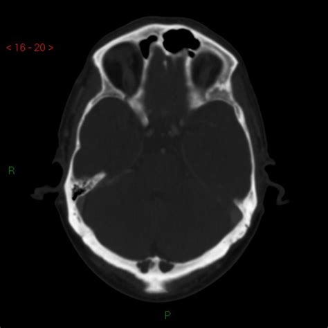 Intraosseous Arachnoid Granulations Image