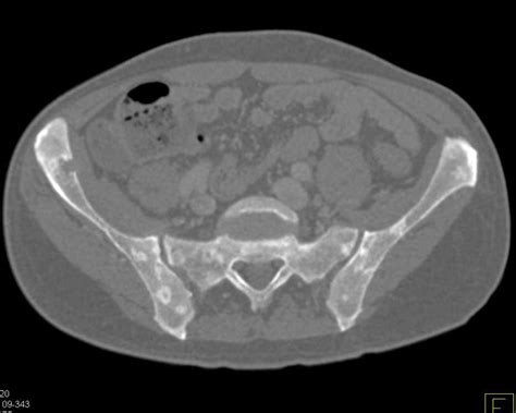 Multiple Sclerotic Bone Lesions Due To Myeloma Musculoskeletal Case