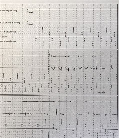 Recordings Of Intracardiac Atrial And Ventricular Electrogram Egm Download Scientific Diagram