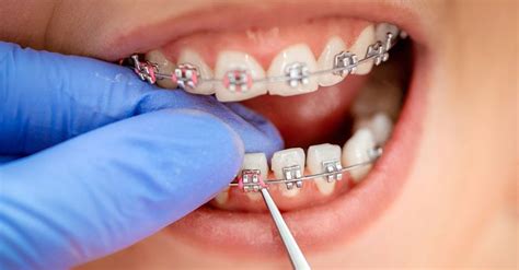 How Can Orthodontic Treatment Help You