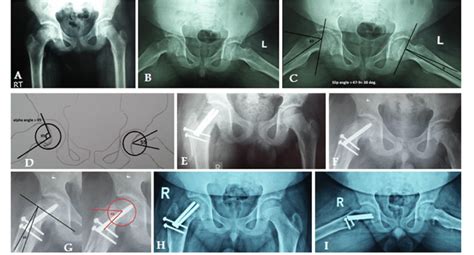 X-ray in 15-year-old male with Rt chronic stable SCFE (case number 4):... | Download Scientific ...