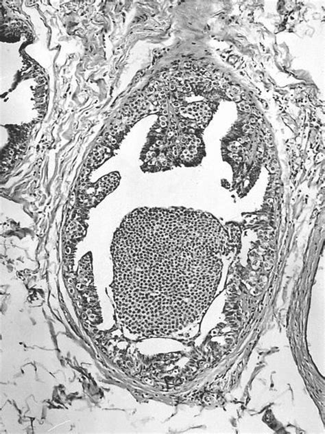 Pathology Outlines Intraductal Papilloma