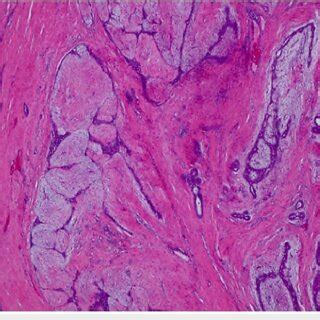 Cm Right Breast Mass Showing A Benign Phyllodes Tumor With Positive