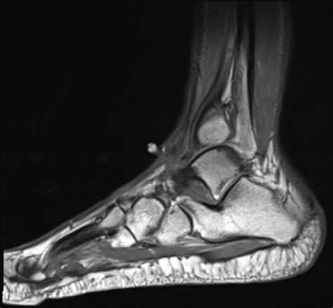 An Atypical Soft Tissue Mass On The Dorsum Of The Foot A Case Report