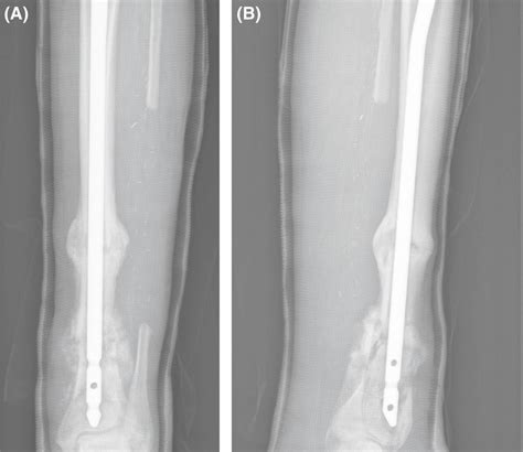 A And B Anteroposterior And Lateral Radiography Following