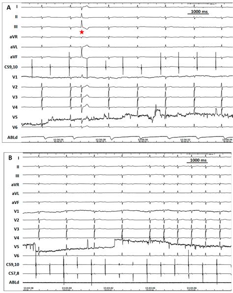 Jcdd Free Full Text Complete Atrioventricular Block Caused By