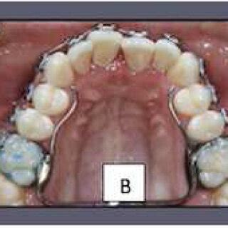 A Maxillary Removable Hawley Expansion Appliances With Midline Screw