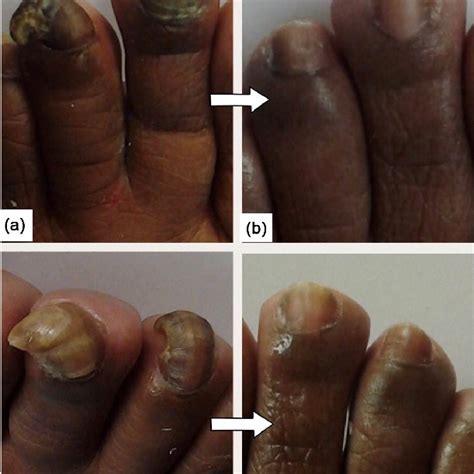 (a) and (c) Depiction of before nail restoration surgical procedure ...