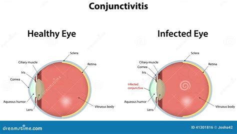 Conjunctivitis Stock Vector Illustration Of Infected 41301816