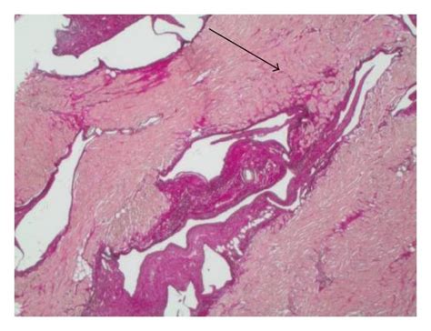 Explanted Heart Of A Year Old Patient With Failing Fontan A