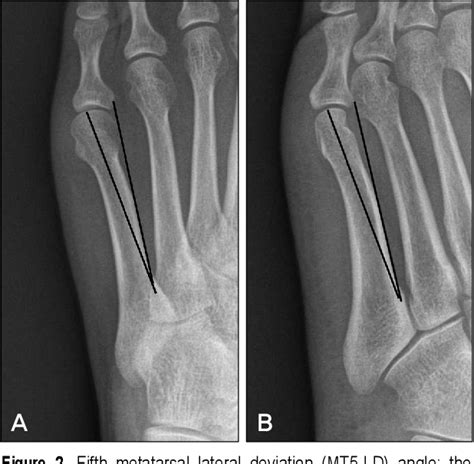 Figure From Fifth Metatarsal Stress Fracture Semantic Scholar