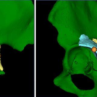 Simulation of fracture reduction. An anatomical reduction in all three ...