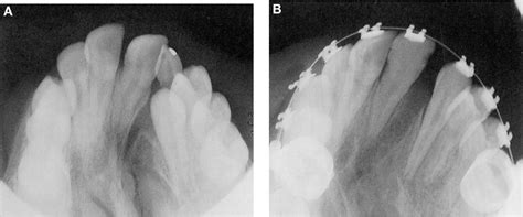 Figure From Management Of Alveolar Clefts Semantic Scholar