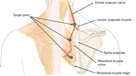 Dorsal scapular nerve entrapment syndrome Symptoms, Treatment