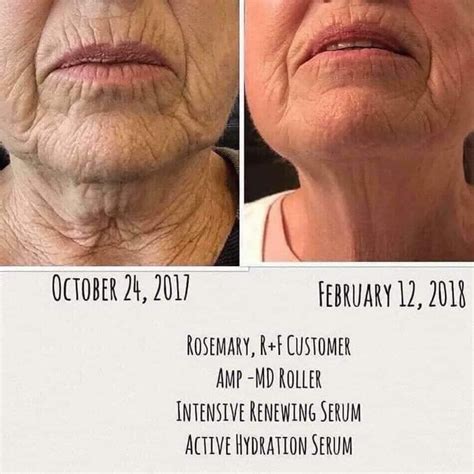 Yet More Amazing Results From Rodan Fields Amp Md Roller Intensive