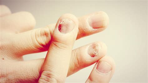 Nail Psoriasis vs. Fungus: What’s the Difference? - TheWellthieone