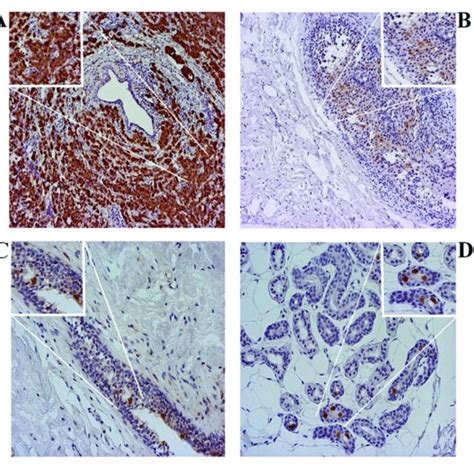 P16 Ihc Different Subcellular Localizations A Ibc Dominant