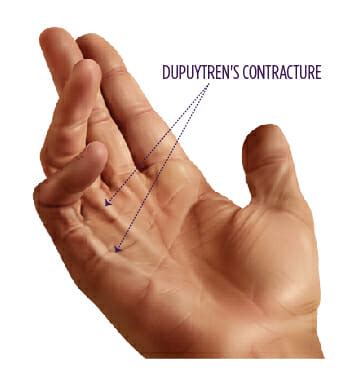 What You Need To Know About Dupuytrens Contracture Or Vikings Hand