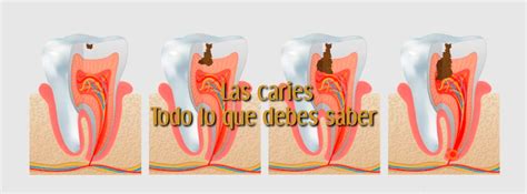 La caries dental Síntomas causas prevención y tratamientos