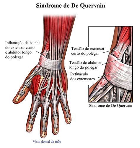 Dor No Punho Direito Ou Esquerdo Causas E Tratamento
