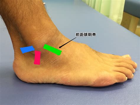 前距腓靭帯損傷（足首外側の捻挫）｜中山町で背骨・骨盤矯正などの施術を行う大沢接骨院