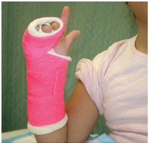 Ulnar Gutter Cast - WikiSM (Sports Medicine Wiki)