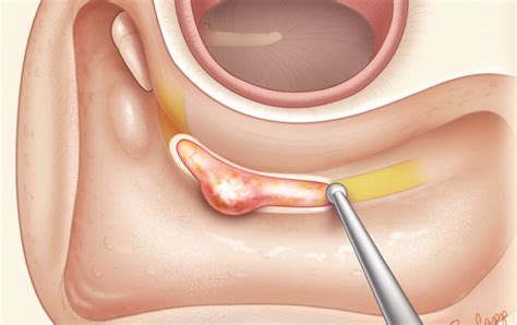 The Facial Nerve In Mastoidectomy Oto Surgery Atlas