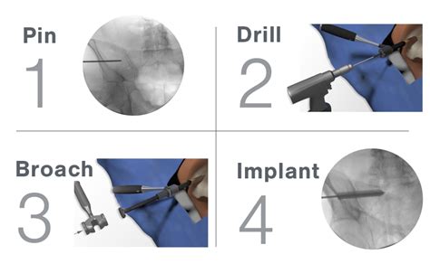 Ifuse 3d™ Si Bone