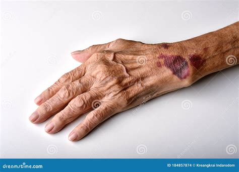 A Wound On The Skin. Close Royalty-Free Stock Image | CartoonDealer.com ...