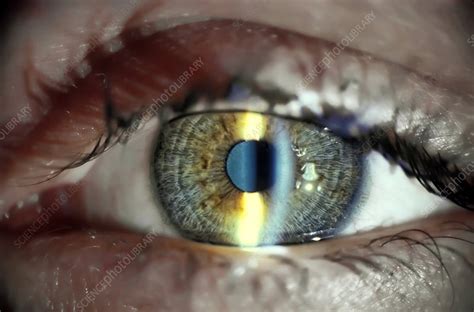 Slit lamp eye examination - Stock Image - C010/9554 - Science Photo Library