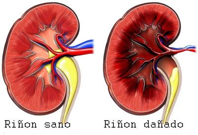 Granulomatosis de Wegener Enciclopedia Médica Ferato