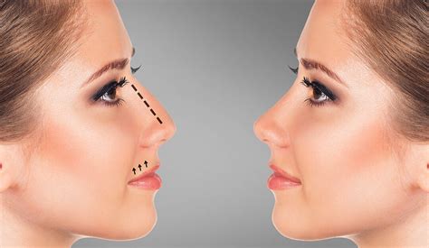 Tarif Rhinoplastie Tunisie Chirurgie Du Nez Prix Tout Compris