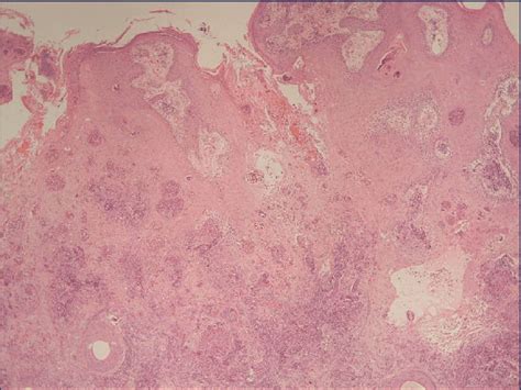 Squamous Pseudo Epitheliomatous Hyperplasia Abscesses And Giant Cells