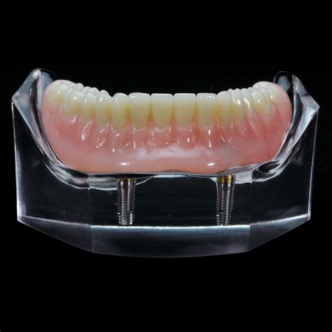 IM-10 Locator Overdenture (2 Zest Abutments over Implants) | Paradigm ...