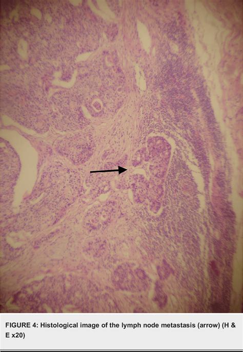 Figure 3 From A Rare Case Of Perforated Caecal Cancer Disguised As A