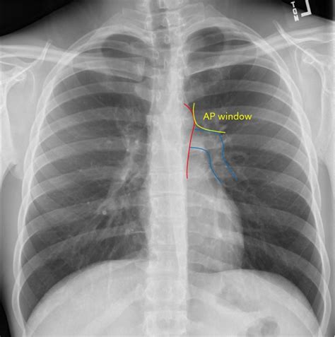 Chest Radiograph