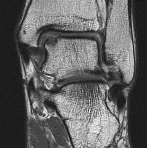 Osteochondral Lesion Of The Talus