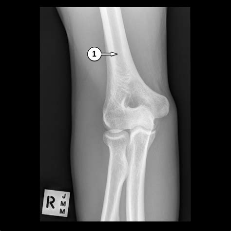 Embarazada Diversidad Produce Elbow Xray Anatomy Disfraz Direcci N Muerto