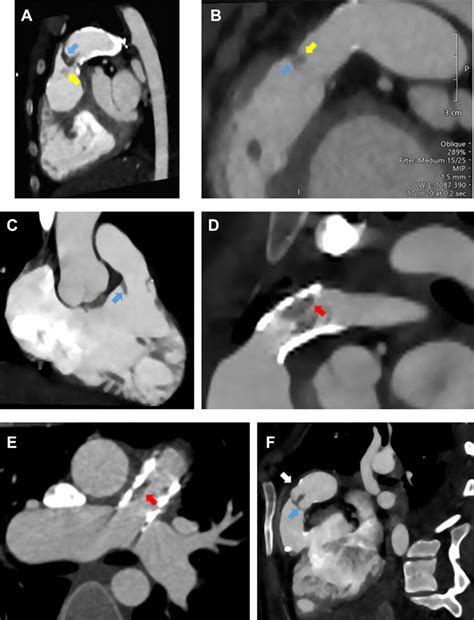 Cardiac Cta Findings For Pulmonary Valve Infective Endocarditis Download Scientific Diagram