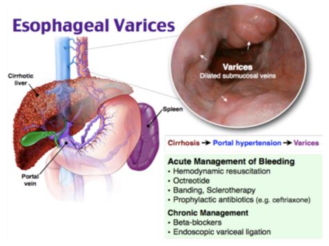 Balloon Tamponade In Gi Bleed Usf Emergency Medicine